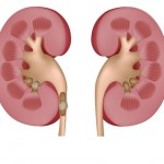 Kidney Stones What are they Symptoms and Treatment
